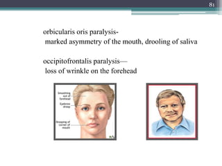 orbicularis oris paralysis-
marked asymmetry of the mouth, drooling of saliva
occipitofrontalis paralysis—
loss of wrinkle on the forehead
81
 