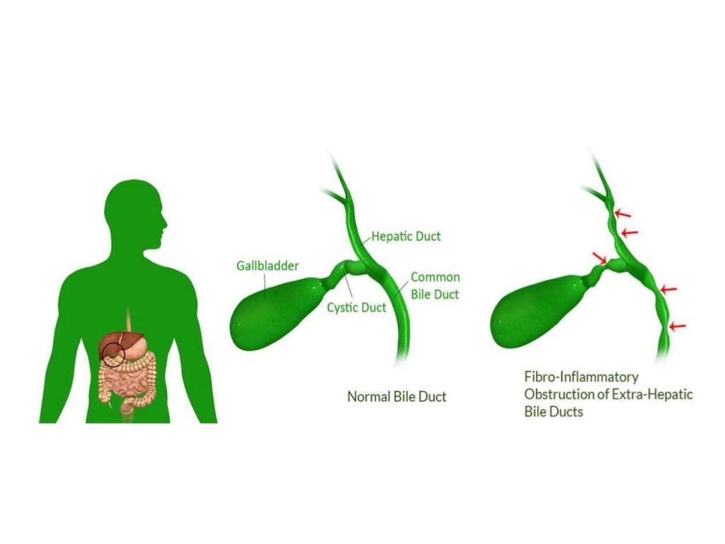 Neonatal Cholestasis