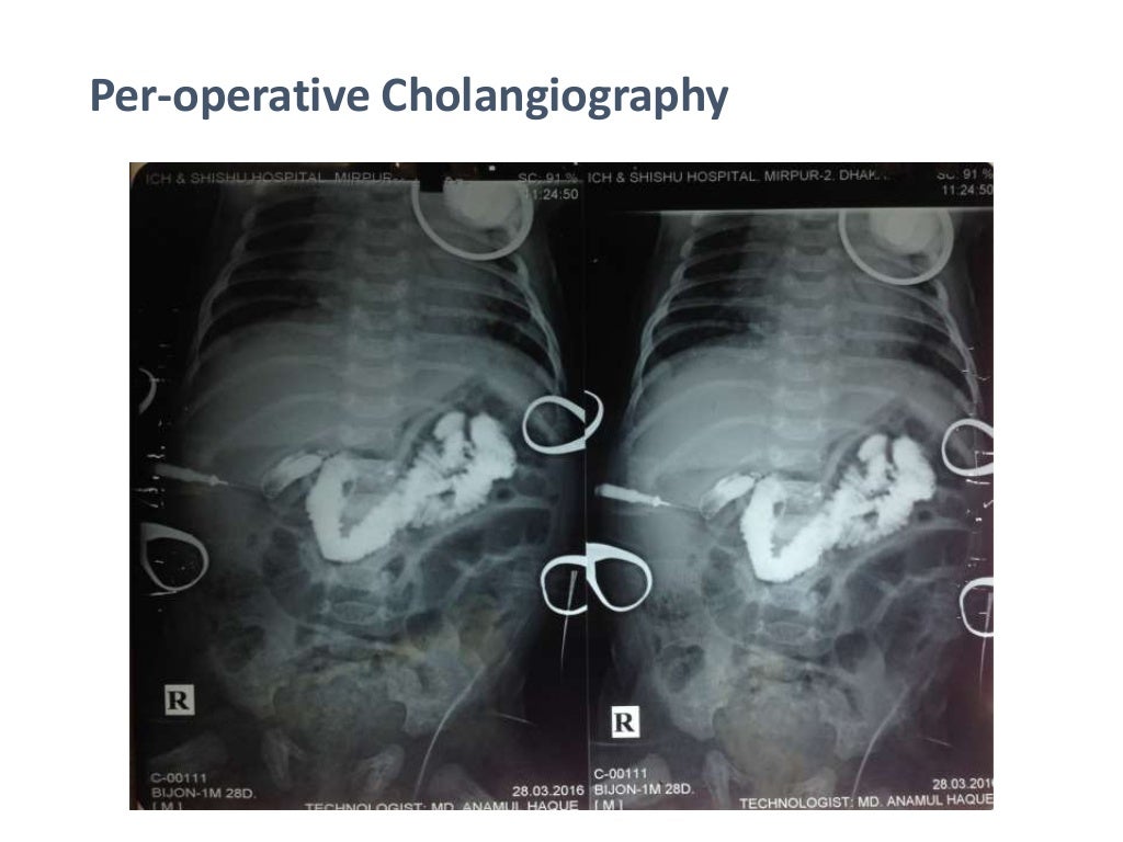 Neonatal Cholestasis