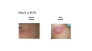 Vesication Vesiculobullous lesions of skin including intraepidermal and ...