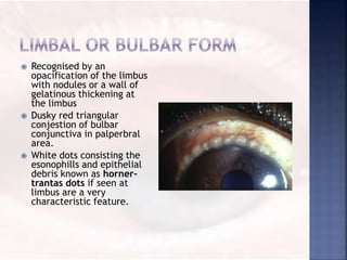  Recognised by an
opacification of the limbus
with nodules or a wall of
gelatinous thickening at
the limbus
 Dusky red triangular
conjestion of bulbar
conjunctiva in palperbral
area.
 White dots consisting the
esonophills and epithelial
debris known as horner-
trantas dots if seen at
limbus are a very
characteristic feature.
 