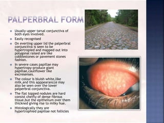  Usually upper tarsal conjunctiva of
both eyes involved.
 Easily recognised
 On everting upper lid the palperbral
conjunctiva is seen to be
hypertropied and mapped out into
polygonal raised are like
cobblestones or pavement stones
fashion.
 In severe cases papillae may
hypertropy-produce giant
papillae,cauliflower like
excresenses.
 The colour is bluish white,like
milk,and this apppearancce may
also be seen over the lower
palperbral conjunctiva.
 The flat topped nodules are hard
consist cheifly of dense fibrous
tissue,but the epithelium over them
thickned giving rise to milky hue.
 Histologically they are
hypertrophied papillae not follicles
 