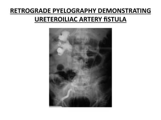 RETROGRADE PYELOGRAPHY DEMONSTRATING
URETEROILIAC ARTERY ﬁSTULA
 