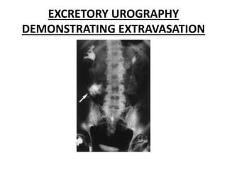 EXCRETORY UROGRAPHY
DEMONSTRATING EXTRAVASATION
 