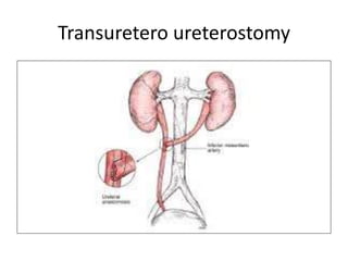 Transuretero ureterostomy
 