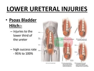 LOWER URETERAL INJURIES
• Psoas Bladder
Hitch:-
– injuries to the
lower third of
the ureter
– high success rate
- 95% to 100%
 