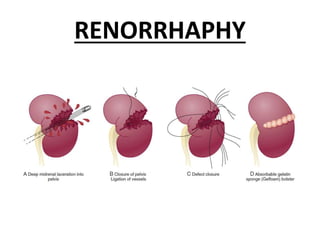 RENORRHAPHY
 
