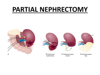 PARTIAL NEPHRECTOMY
 