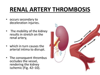 RENAL ARTERY THROMBOSIS
• occurs secondary to
deceleration injuries.
• The mobility of the kidney
results in stretch on the
renal artery,
• which in turn causes the
arterial intima to disrupt.
• The consequent thrombus
occludes the vessel,
rendering the kidney
ischemic (Fig. 42–10).
 