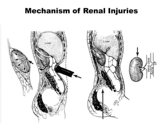 Mechanism of Renal Injuries
 