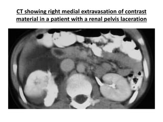CT showing right medial extravasation of contrast
material in a patient with a renal pelvis laceration
 