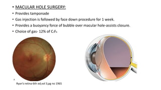 Vitreous substitutes in ophthalmology | PPTX