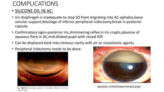 Peripheral Inverse Vitreous substitutes in ophthalmology | PPTX