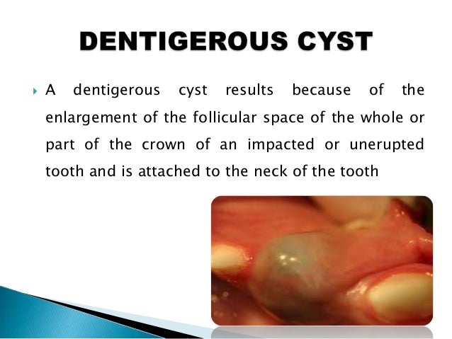 odontogenic cysts odontogenic cyst
