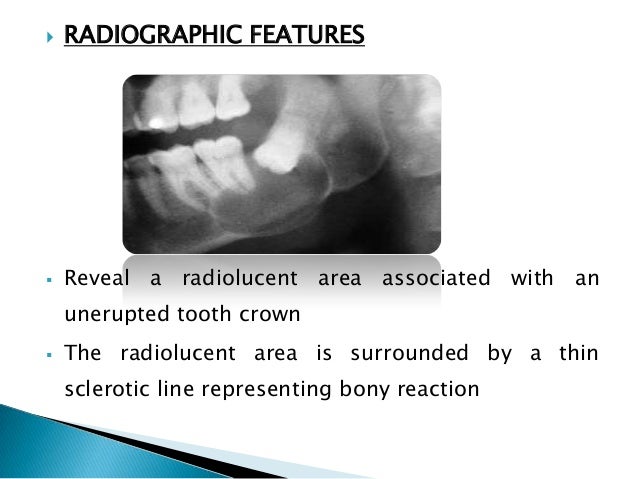 odontogenic cysts odontogenic cyst