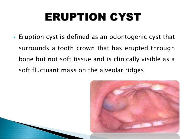 odontogenic cysts odontogenic cyst