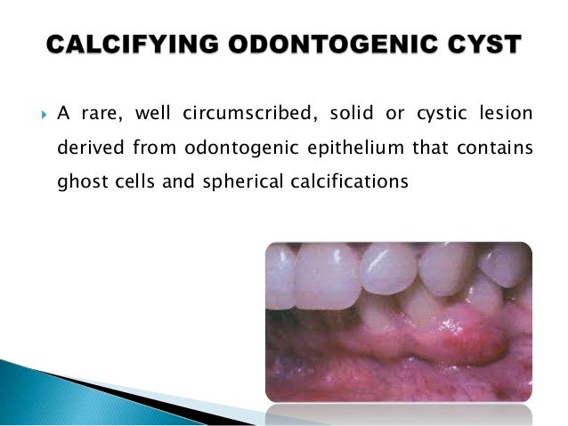 odontogenic cysts odontogenic cyst