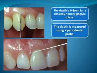 The depth is 0-3mm for a
clinically normal gingival
sulcus.
The depth is measured
using a periodontal
probe.
 