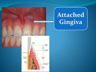 Attached
Gingiva
 
