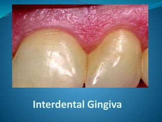 Interdental Gingiva
 