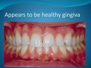 Appears to be healthy gingiva
 