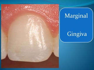 Marginal
Gingiva
 