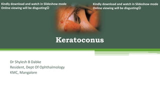 Dr Shylesh B Dabke
Resident, Dept Of Ophthalmology
KMC, Mangalore
Keratoconus
Kindly download and watch in Slideshow mode
Online viewing will be disgusting
Kindly download and watch in Slideshow mode
Online viewing will be disgusting
 