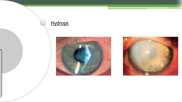 Keratoconus - Dr Shylesh B Dabke