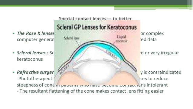 Keratoconus Dr Shylesh B Dabke