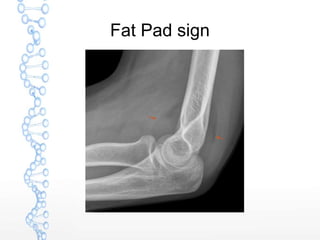 Fat Pad sign
 