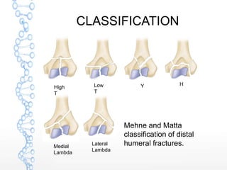 CLASSIFICATION
Mehne and Matta
classification of distal
humeral fractures.
High
T
Low
T
Y H
Medial
Lambda
Lateral
Lambda
 
