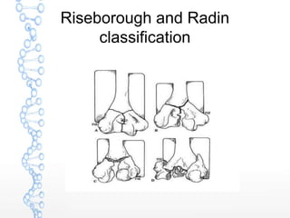 Riseborough and Radin
classification
 