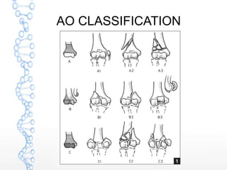 AO CLASSIFICATION
 