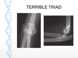 TERRIBLE TRIAD
 