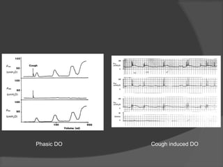 Cough induced DOPhasic DO
 