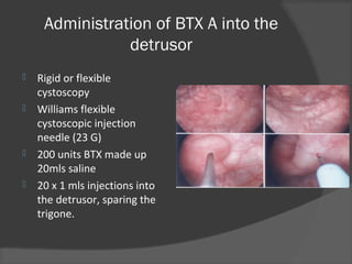 Administration of BTX A into the
detrusor
 Rigid or flexible
cystoscopy
 Williams flexible
cystoscopic injection
needle (23 G)
 200 units BTX made up
20mls saline
 20 x 1 mls injections into
the detrusor, sparing the
trigone.
 