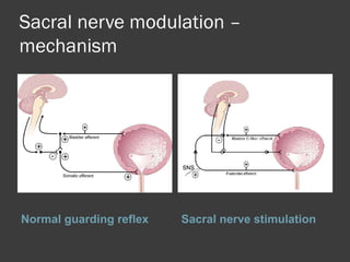 Sacral nerve modulation –
mechanism
Normal guarding reflex Sacral nerve stimulation
 