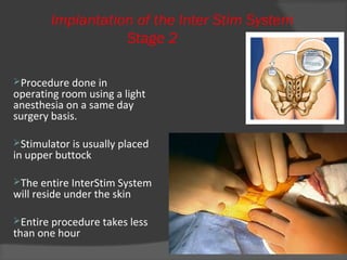 Procedure done in
operating room using a light
anesthesia on a same day
surgery basis.
Stimulator is usually placed
in upper buttock
The entire InterStim System
will reside under the skin
Entire procedure takes less
than one hour
 