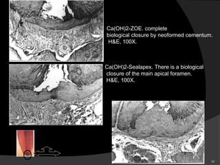 Ca(OH)2-ZOE. complete
biological closure by neoformed cementum.
H&E, 100X.
Ca(OH)2-Sealapex. There is a biological
closure of the main apical foramen.
H&E, 100X.
56
 
