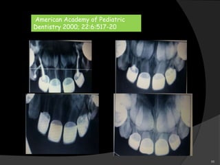 American Academy of Pediatric
Dentistry 2000; 22:6:517-20
66
 