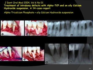 J Dent Oral Med 2004, Vol 6 No 01
Treatment of intrabony defects with Alpha-TCP and an oily Calcium
Hydroxide suspension. A 14-case-report
Alpha-Tricalcium Phosphate + oily Calcium Hydroxide suspension
68
 