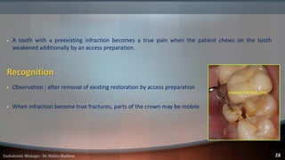 Infraction Tooth Endodontic Mishaps | PDF