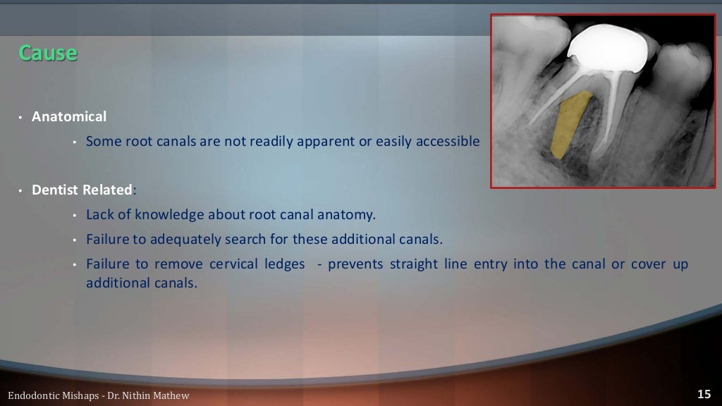 Endodontic Mishaps