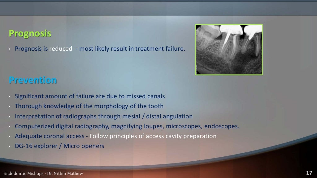 Endodontic Mishaps