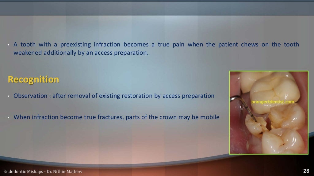 Endodontic Mishaps