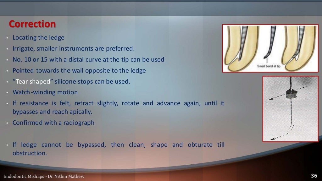 Endodontic Mishaps