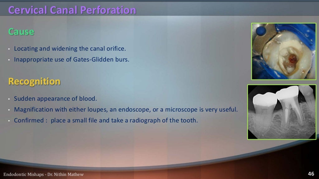 Endodontic Mishaps
