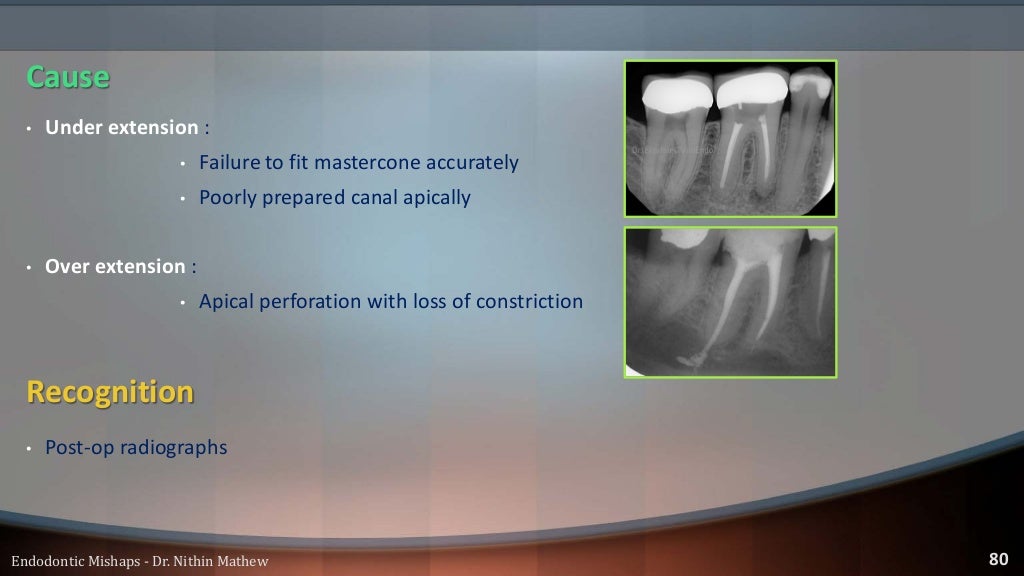 Endodontic Mishaps