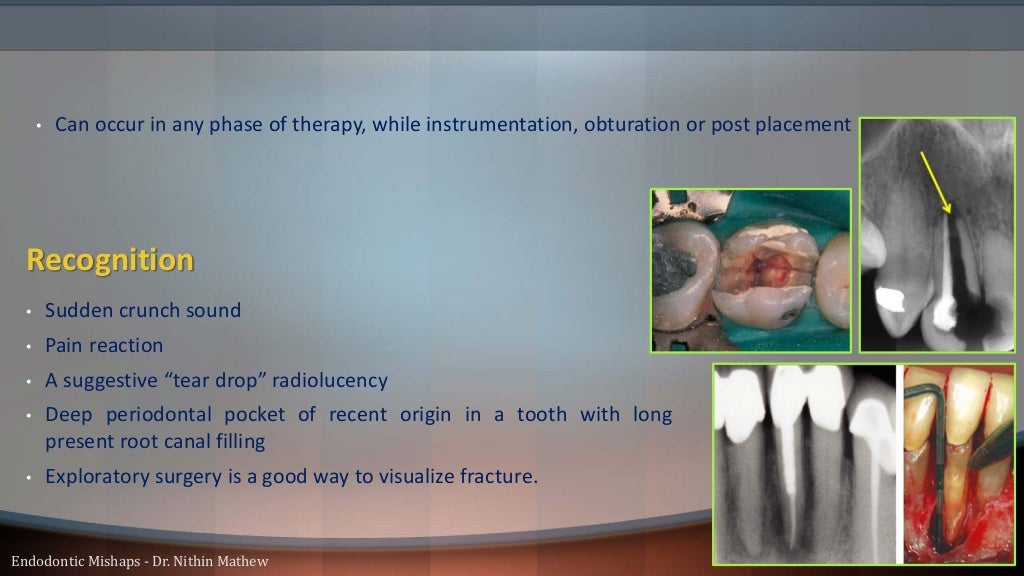 Endodontic Mishaps