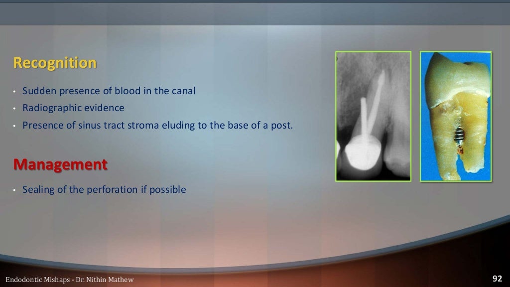 Endodontic Mishaps